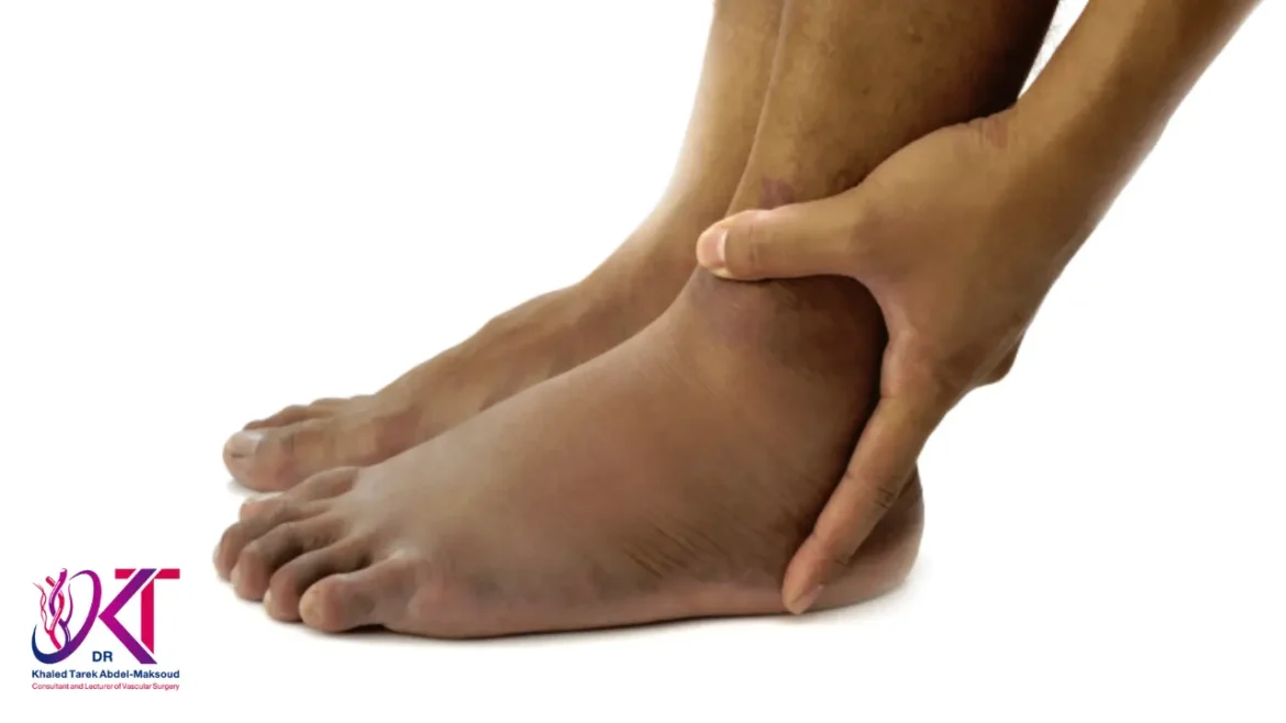 دكتور اوعيه دمويه وقدم سكري