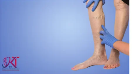 أسباب ظهور الدوالي في سن مبكر
