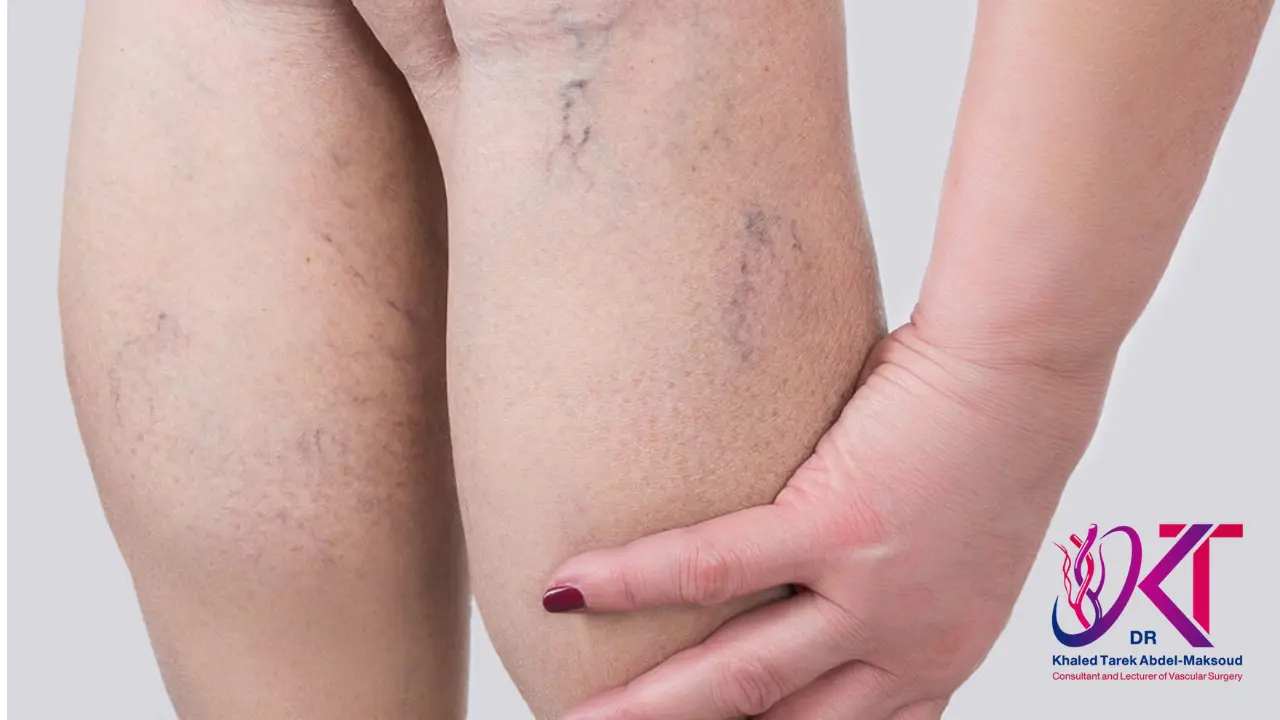 مخاطر الدوالي عند النساء