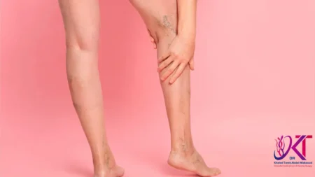 أنواع الدوالي عند النساء