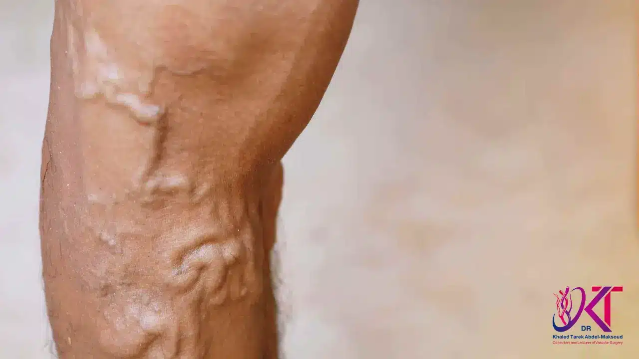 اسباب دوالي الساقين​