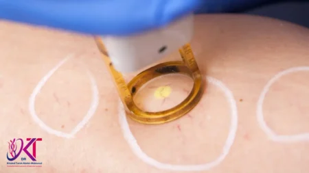 نسبة نجاح عملية دوالي الساقين