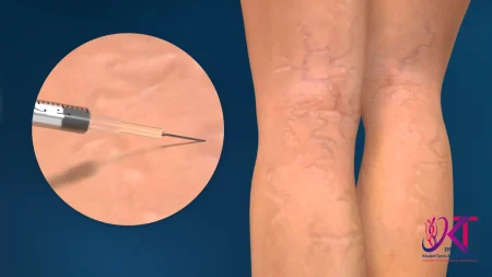 تجربتي مع حقن الدوالي