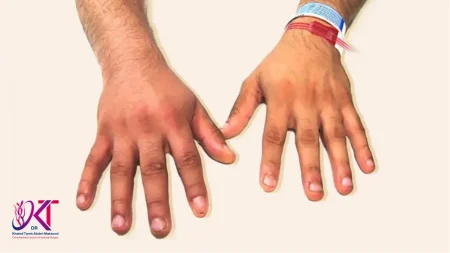 تسليك شرايين اليد