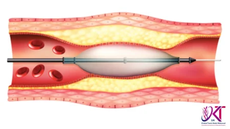 تكلفة عملية تسليك شرايين القدم
