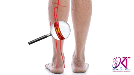 علاج انسداد الأوعية الدموية في القدم